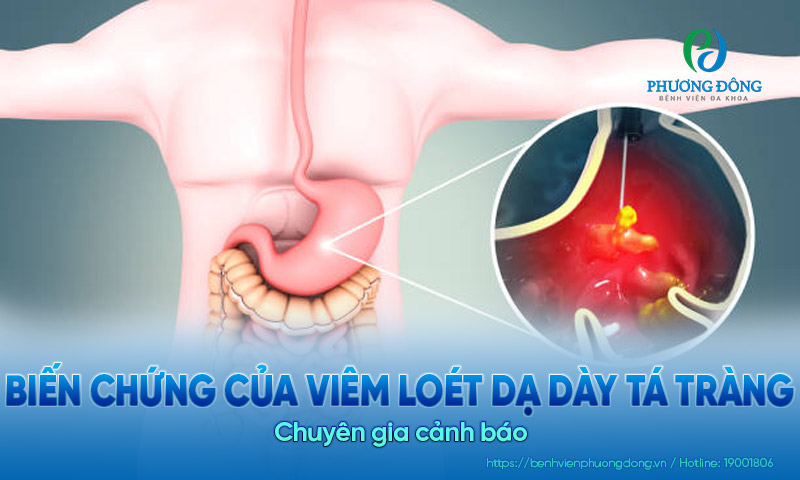 Biến chứng của viêm loét dạ dày tá tràng: Chuyên gia cảnh báo