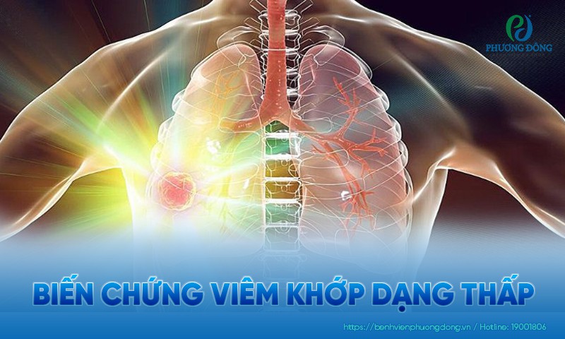 Biến chứng viêm khớp dạng thấp thường gặp và cách kiểm soát