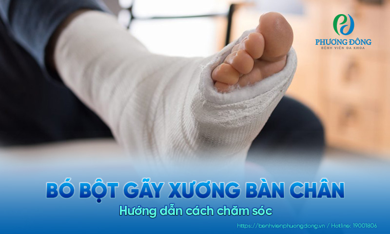 Hướng dẫn chăm sóc khi phải bó bột gãy xương bàn chân 