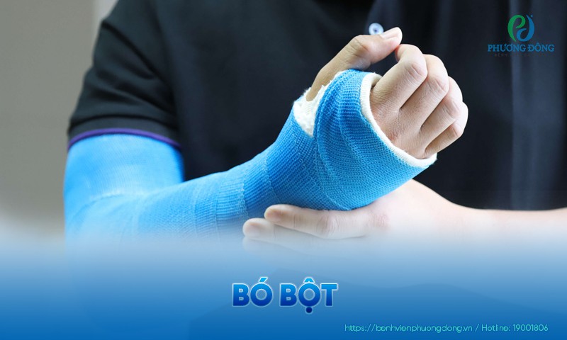 Bó bột là gì? Ưu điểm, quy trình kỹ thuật và phòng ngừa biến chứng