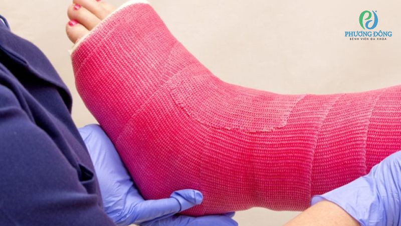 Ưu điểm của phương pháp cố định xương di lệch bằng bột