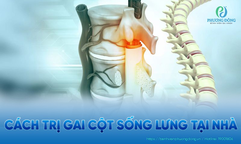 Cách trị gai cột sống thắt lưng tại nhà không thể bỏ qua