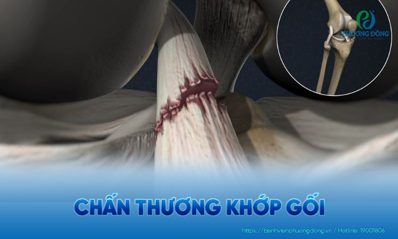 Chấn thương đầu gối: Nguyên nhân, triệu chứng và hướng điều trị
