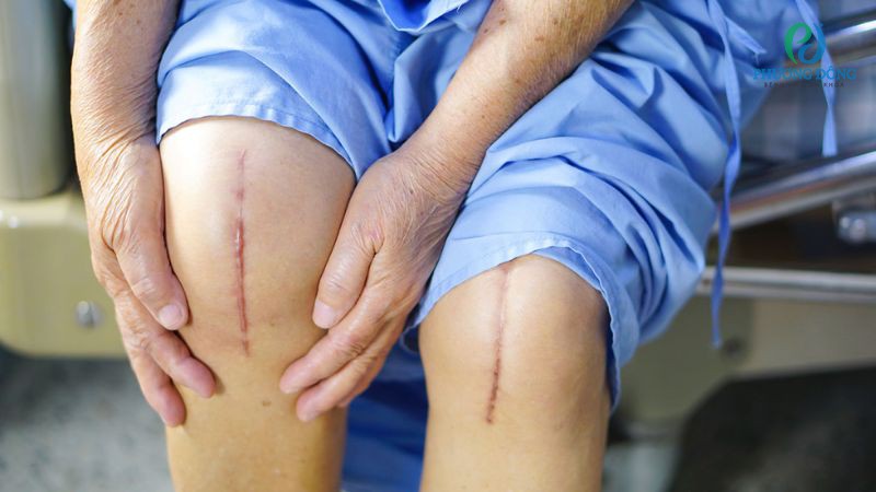 Những trường hợp tổn thương đầu gối cần can thiệp phẫu thuật Sau phẫu thuật, bệnh nhân sẽ bắt đầu tập phục hồi biên độ vận động của khớp. Tiếp đến