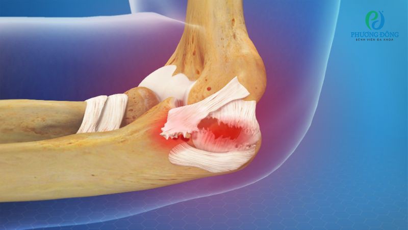 Chấn thương dây chằng béo có thể để lại di chứng nếu không điều trị sớm