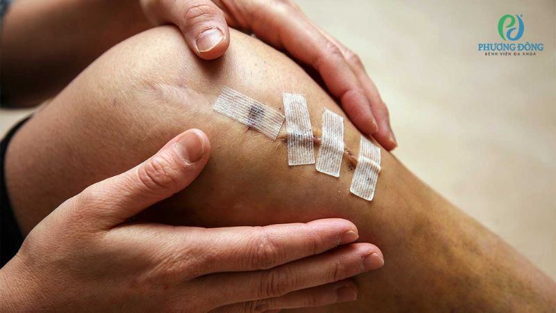 Cẩn trọng với những biến chứng tổn thương khớp gối