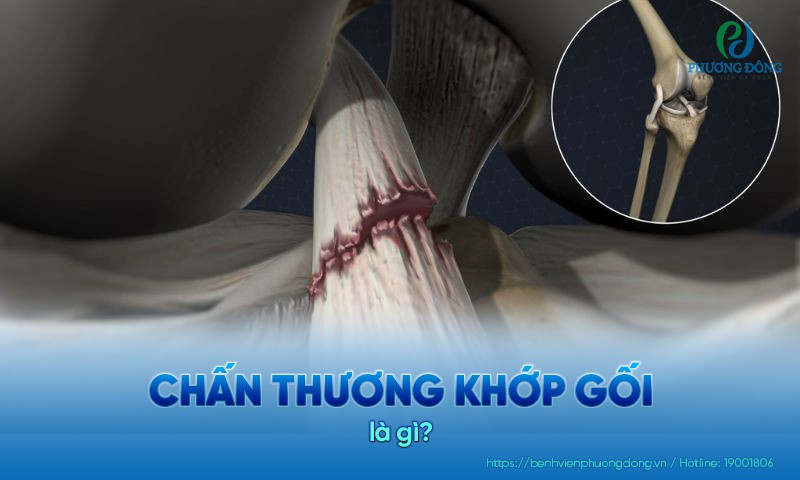 Đứt dây chằng chéo trước là chấn thương đầu gối thường gặp nhất