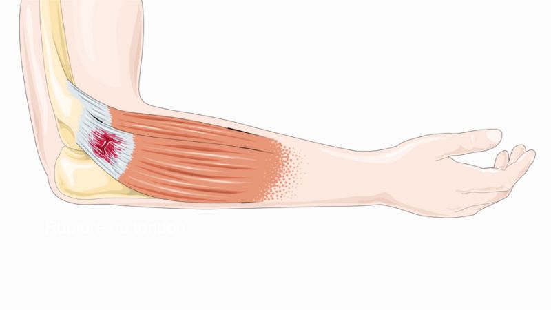 Dây chằng khuỷu tay bị đứt, trở nên lỏng lẻo và mất ổn định