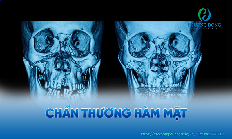 Hàm mặt có thể bị chấn thương do nhiều nguyên nhân khác nhau