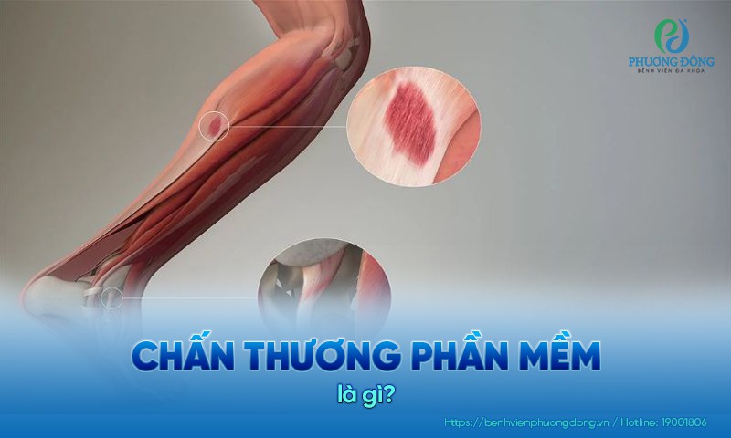 Chấn thương phần mềm xảy ra ở các bộ phận như cơ, gân và dây chằng