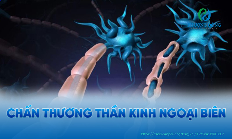 Dây thần kinh ngoại biên có thể bị chấn thương