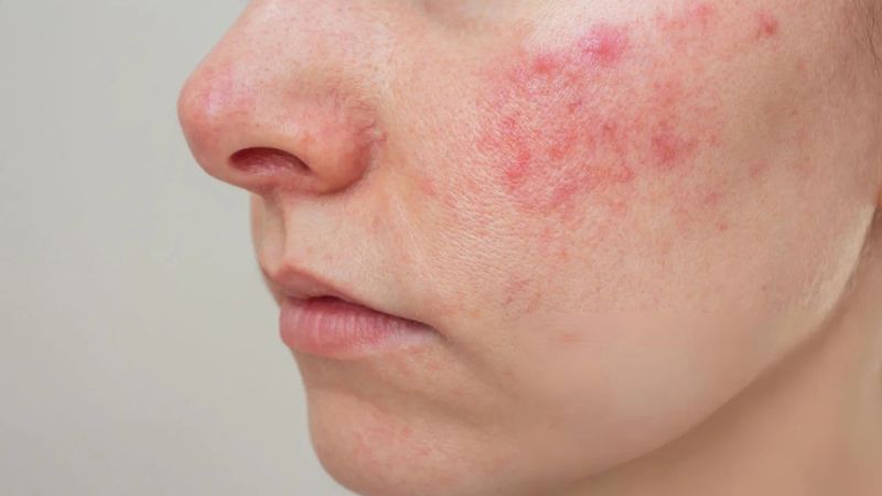 Người bệnh Lupus ban đỏ cũng có thể bị chấn thương dây thần kinh