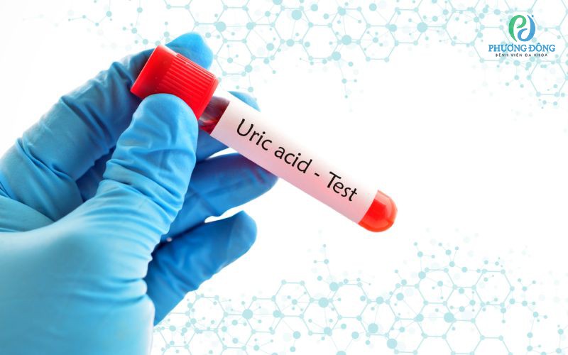 Chỉ số Uric 534 là gì? Chỉ số phản ánh tình trạng sức khỏe như thế nào?