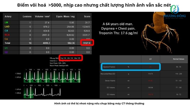 Cung cấp hình ảnh sắc nét ngay cả vùng vôi hóa mạch