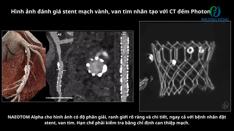 Hình ảnh đánh giá stent mạch vành với công nghệ CT đếm Photon