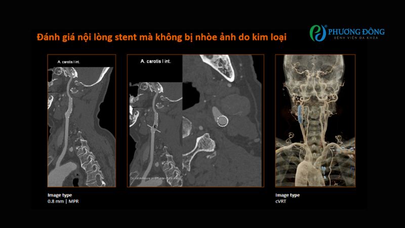 Ảnh chụp CT đánh giá nội lòng stent
