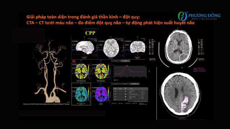 Chụp CT đếm photon giúp phát hiện sớm đột quỵ