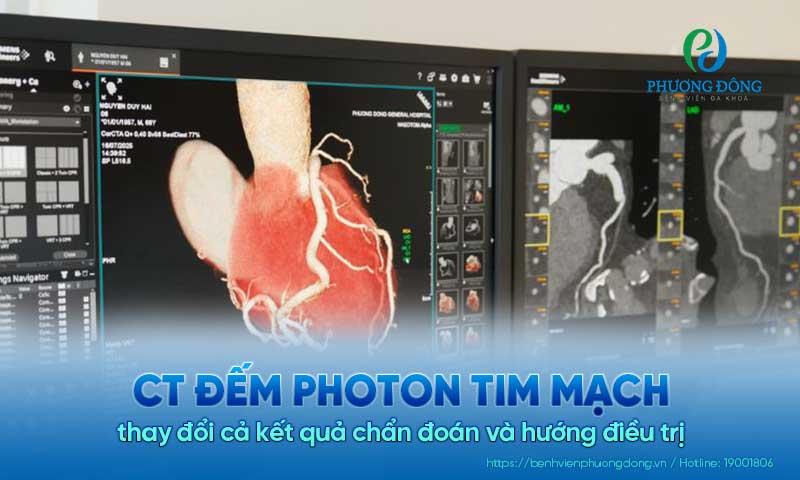 CT đếm photon tim mạch thay đổi cả kết quả chẩn đoán và hướng điều trị