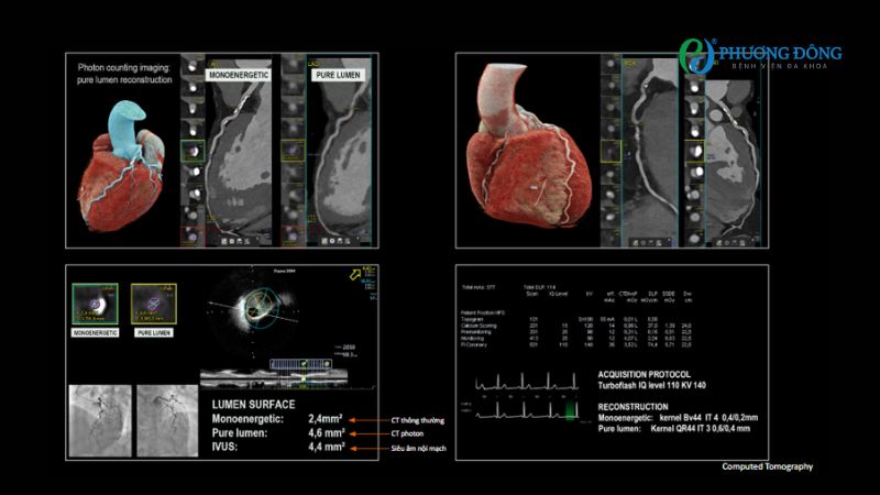 Chất lượng hình ảnh từ phim của máy CT Photon tương đương với siêu âm nội lòng mạch