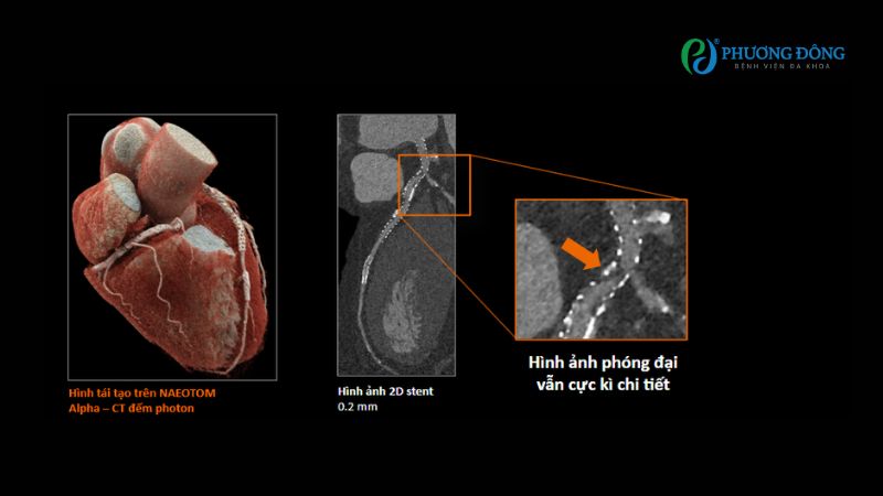 Hình ảnh phóng đại chi tiết sau khi đặt stent mạch vành - điều mà trước đây không quan sát được trên CT thông thường