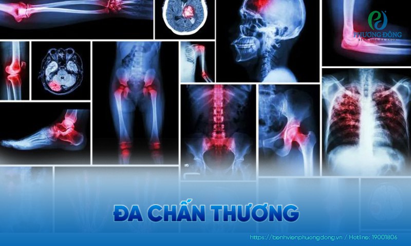 Đa chấn thương gây rối loạn chức năng gì? Cách điều trị và chăm sóc