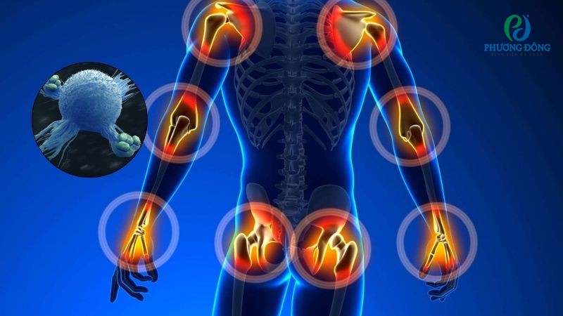 Sức đề kháng suy yếu khiến cơn đau trầm trọng hơn khi chuyển mùa