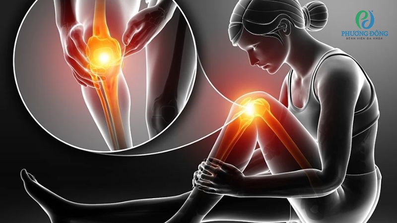Viêm khớp là nguyên nhân gây đau nhức xương khớp khi trời chuyển lạnh