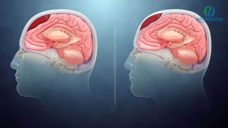 Máu tụ nội sọ ảnh hưởng đến vận động, ngôn ngữ, cảm giác và nhận thức