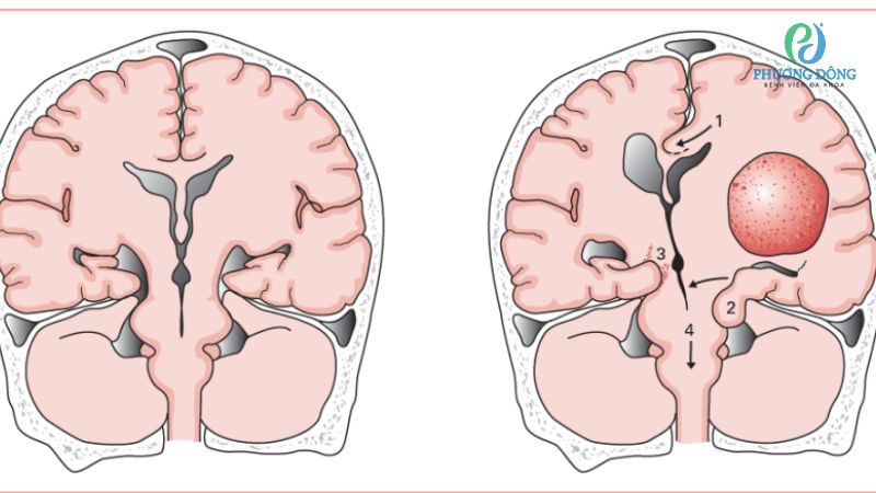Tăng áp lực nội sọ khiến người bệnh liên tục nôn mửa, co giật, động kinh hoặc đau đầu