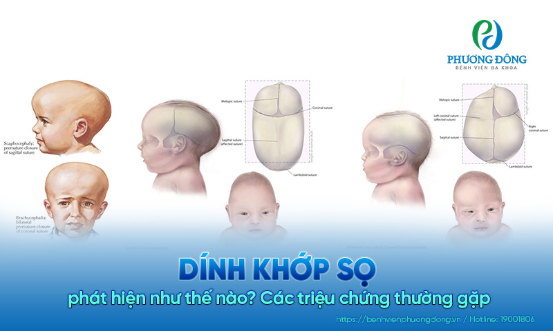 Dính khớp sọ phát hiện như thế nào? Các triệu chứng thường gặp