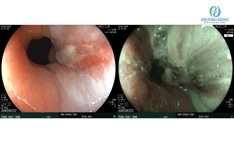 Đừng chủ quan với bệnh trào ngược dạ dày - thực quản: Cảnh báo các biến chứng nguy hiểm