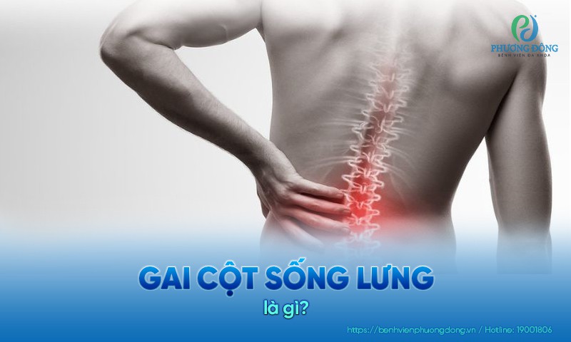 Gai cột sống không ảnh hưởng đến tính mạng nhưng có thể ảnh hưởng đến sinh hoạt