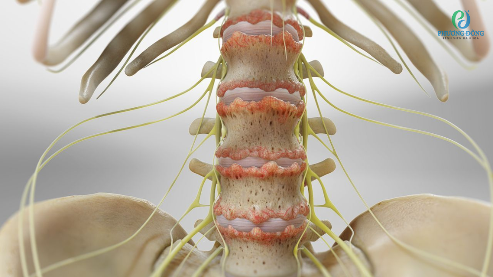 Triệu chứng nhận biết gai xương sống lưng