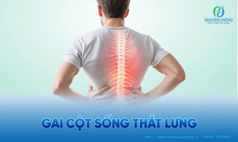 Gai cột sống thắt lưng: Nguyên nhân, triệu chứng và điều trị