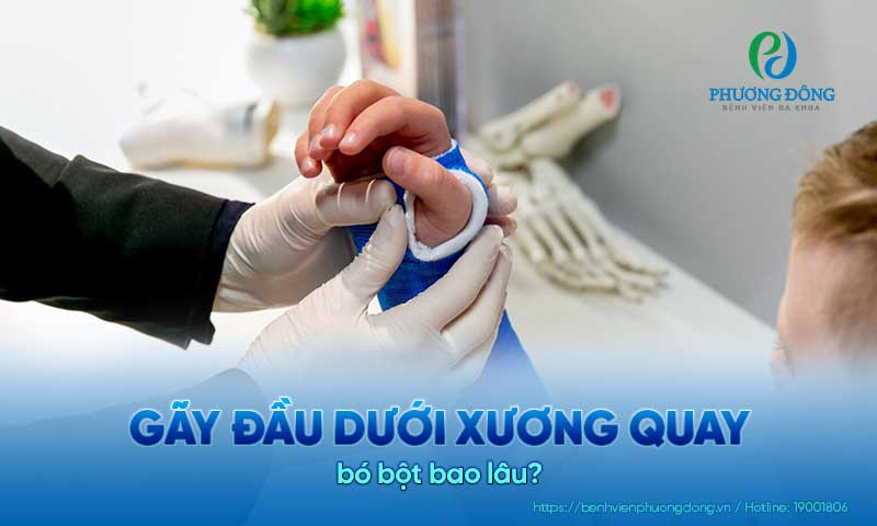 Gãy đầu dưới xương quay bó bột bao lâu?