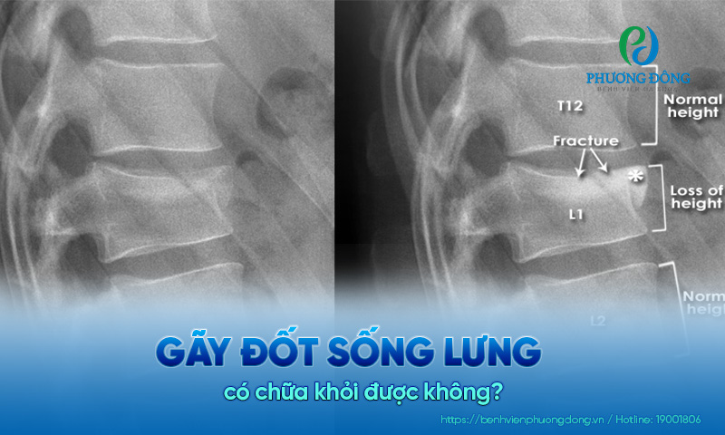 Gãy đốt sống lưng có chữa khỏi được không? Gãy đốt sống lưng có chữa khỏi được không?