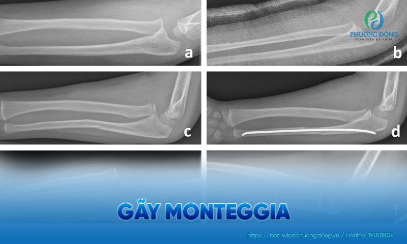 Gãy monteggia: Triệu chứng, chẩn đoán và hướng điều trị