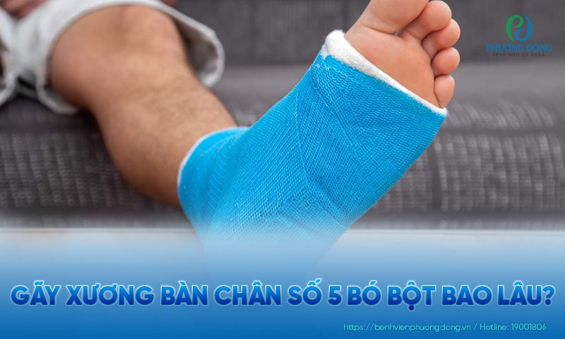 Gãy xương bàn chân số 5 bó bột bao lâu? Các phương pháp điều trị khác