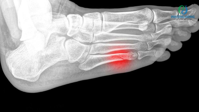 Dấu hiệu cảnh báo gãy xương bàn chân số 5 chuyển biến nguy hiểm