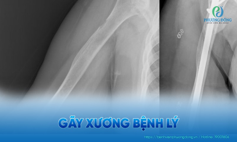 Gãy xương bệnh lý: Biểu hiện, nguyên nhân và hướng điều trị
