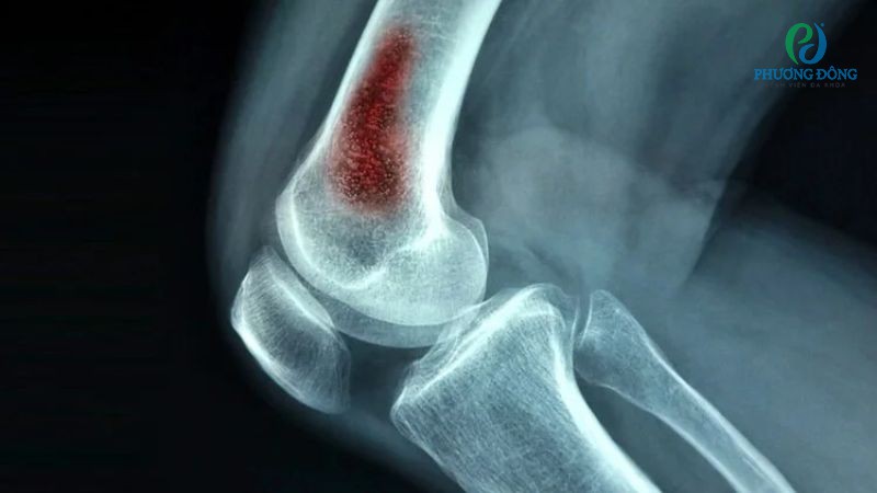 Một số biến chứng gãy xương cần thận trọng