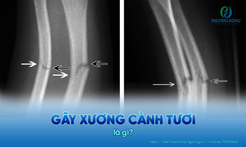 Gãy xương cành tươi là tình trạng xương bị uốn cong, nứt nhưng không vỡ nhiều mảnh