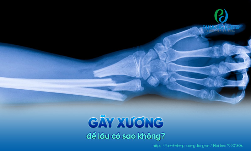 Giải đáp chuyên khoa: Gãy xương để lâu có sao không?