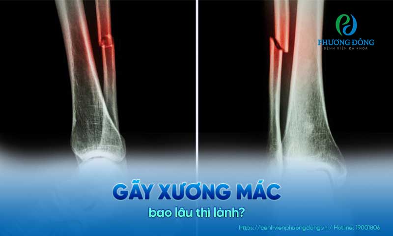 Gãy xương mác bao lâu thì lành ?