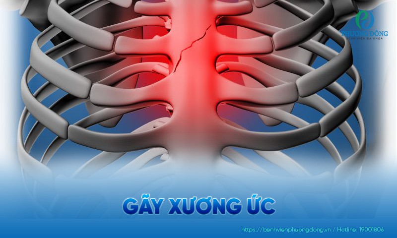 Gãy xương ức: Nguyên nhân, biểu hiện và hướng điều trị