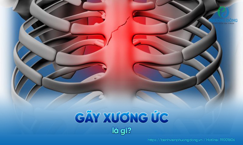 Gãy xương ức là tình trạng nứt vỡ do xương chịu ngoại lực lớn