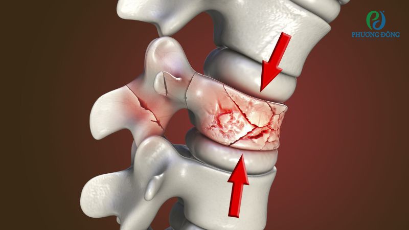 Nguyên nhân khiến lưng người bị gù, cong vẹo