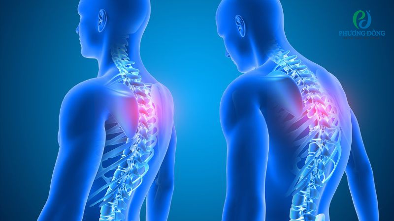 Gù cột sống khiến cơ lưng yếu dần, ảnh hưởng đến tiêu hoá và thẩm mỹ