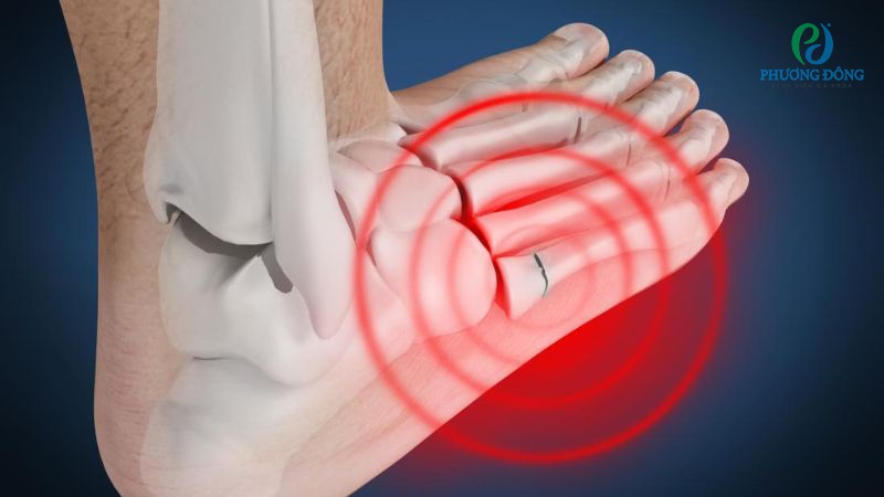 Gãy xương bàn chân thường hết sưng sau vài ngày đến một tuần