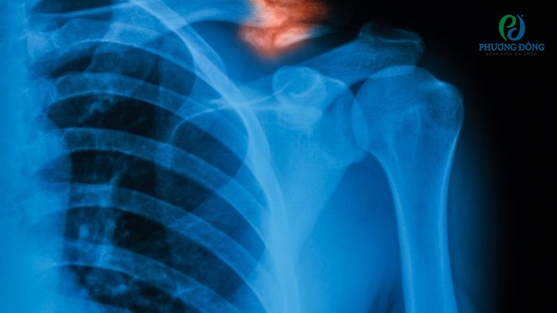 Gãy xương đòn cần 3 - 6 tháng điều trị và phục hồi chức năng